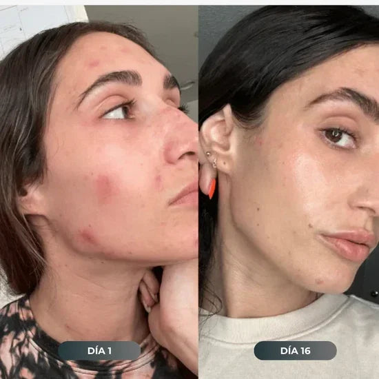 Antes y después piel