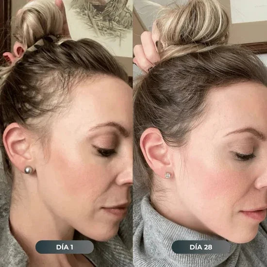 Antes y después caída de cabello
